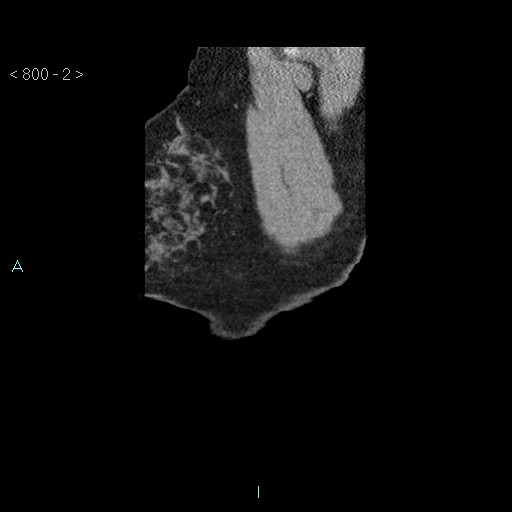 Bronchogenic cyst - posterior mediastinal (Radiopaedia 43885-47364 B 1).jpg