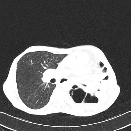 File:Bronchopleural fistula secondary to tuberculosis (Radiopaedia 20415-20322 Axial lung window 29).jpg