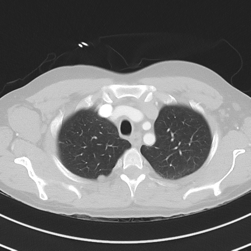 File:Burkitt lymphoma (Radiopaedia 34686-36121 Axial lung window 11).png