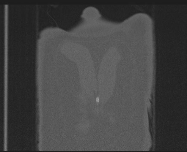 Burst fracture - thoracic spine (Radiopaedia 30238-30865 Coronal bone window 159).jpg