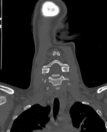 File:Butterfly vertebra (Radiopaedia 77903-90209 Coronal bone window 18).jpg
