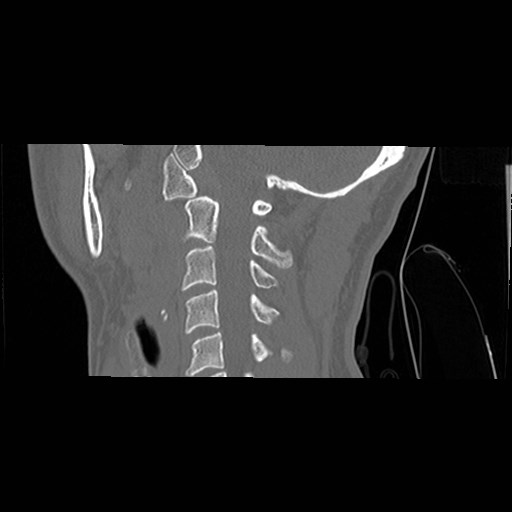 File:C1-C2 "subluxation" - normal cervical anatomy at maximum head rotation (Radiopaedia 42483-45607 C 26).jpg