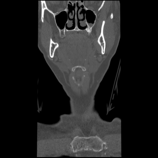 C1 anterior arch (plough) fracture - type 1 (Radiopaedia 76181-87720 Coronal bone window 90).jpg