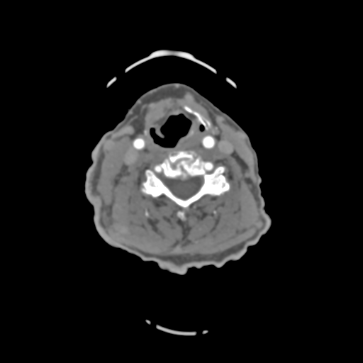 File:C2 fracture with vertebral artery dissection (Radiopaedia 37378-39200 A 123).png