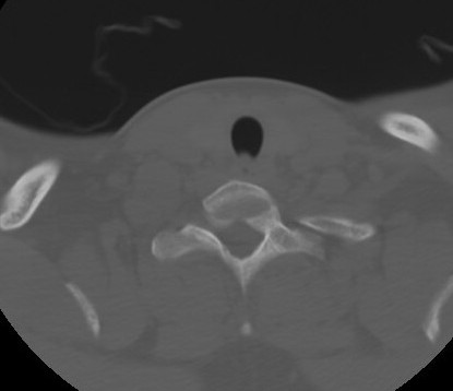 C7 laminar fracture and Klippel-Feil syndrome (Radiopaedia 86710-102850 Axial bone window 62).jpg