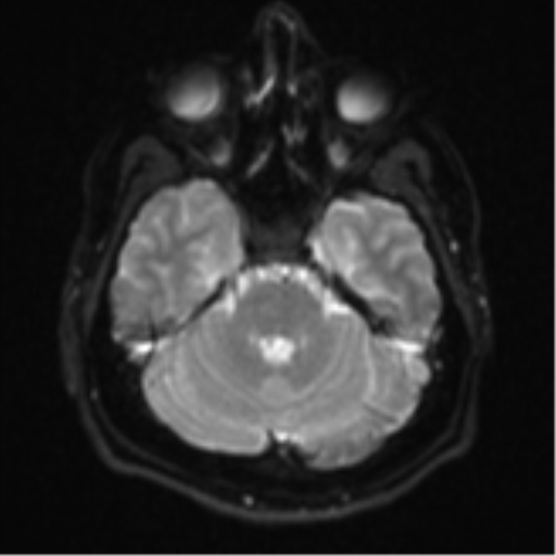 File:CNS vasculitis (Radiopaedia 55715-62263 Axial DWI 8).png