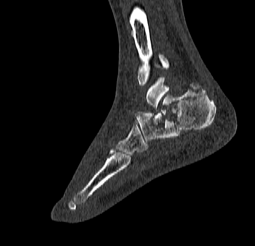 Calcaneal fracture - Sanders type 4 (Radiopaedia 90179-107370 Sagittal bone window 63).jpg
