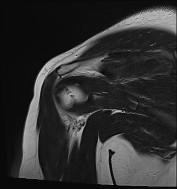 File:Calcific tendinitis of the infraspinatus tendon (Radiopaedia 87256-103537 Coronal T2 15).jpg