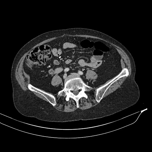Calcified adrenal glands and Spigelian hernia (Radiopaedia 49741-54988 A 148).jpg
