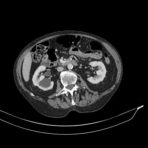Calcified adrenal glands and Spigelian hernia (Radiopaedia 49741-54988 A 94).jpg
