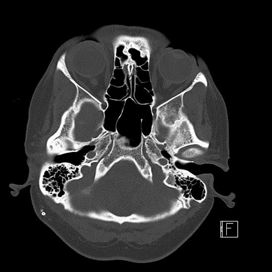 Calcified chronic subdural hematoma (Radiopaedia 77374-89492 Axial bone window 21).jpg