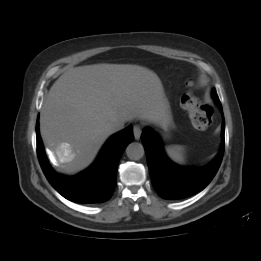 File:Calcified hepatic hydatid cyst (Radiopaedia 18907-18853 Axial non-contrast 6).jpg