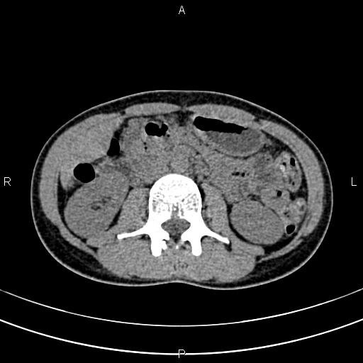 File:Calcified hepatic hydatid cyst (Radiopaedia 83870-99072 Axial non-contrast 84).jpg