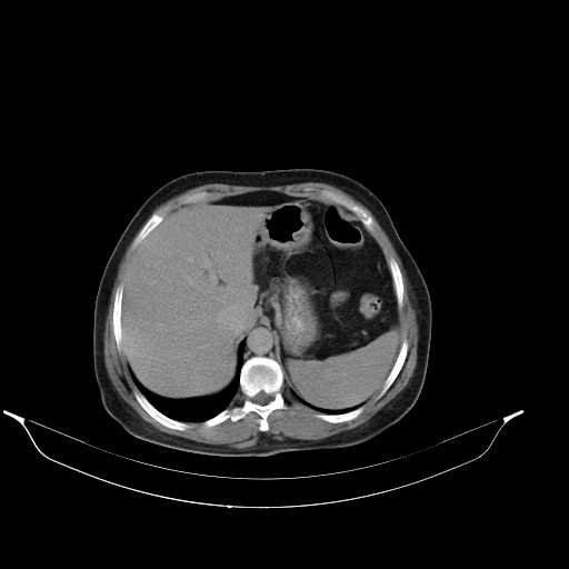 File:Calcified hydatid cyst of the liver (Radiopaedia 21212-21112 Axial C+ delayed 13).jpg