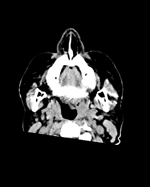 Calcified meningioma (Radiopaedia 74361-85243 Axial non-contrast 64).jpg
