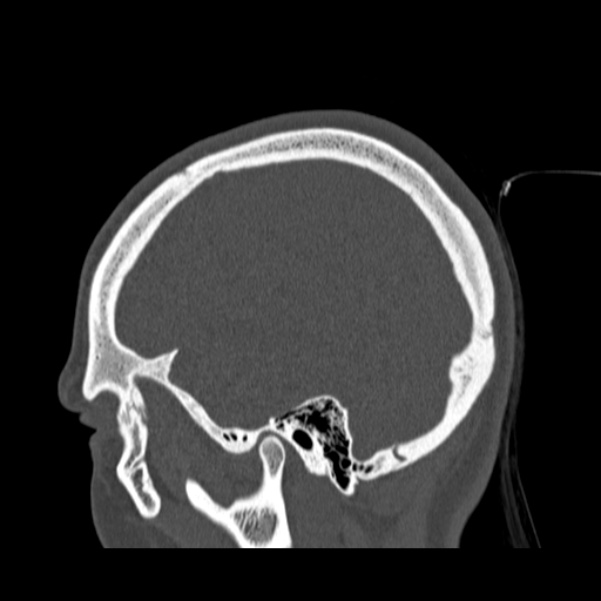 Calvarial osteoma (Radiopaedia 36520-38079 Sagittal bone window 86).jpg