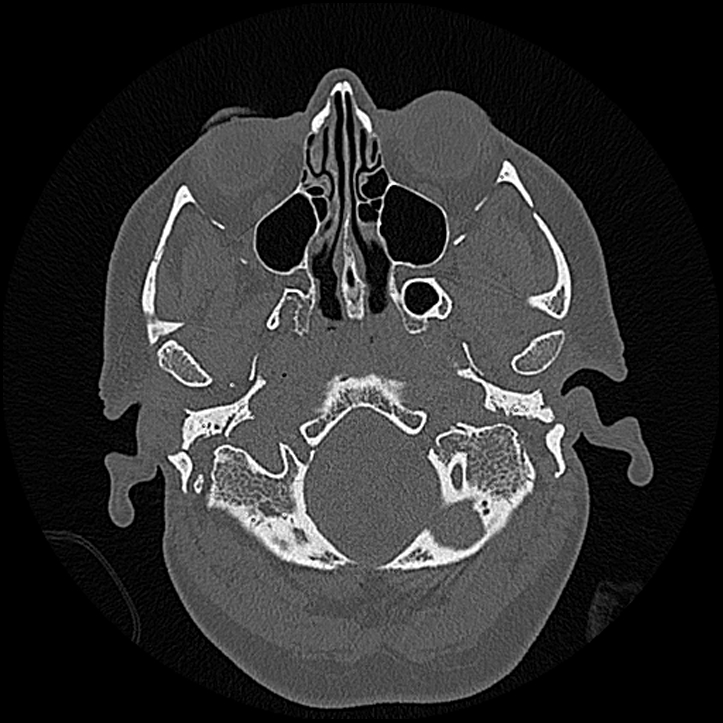 Canal up mastoidectomy (Radiopaedia 78108-90638 Axial bone window 26).jpg