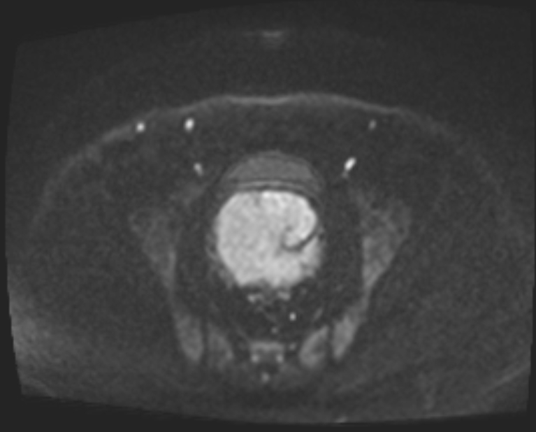 Cancer cervix - stage IIb (Radiopaedia 75411-86615 Axial DWI 73).jpg