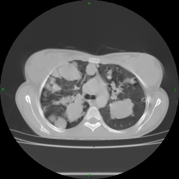 File:Cannon ball metastases - synovial sarcoma (Radiopaedia 26135-26271 Axial lung window 14).jpg
