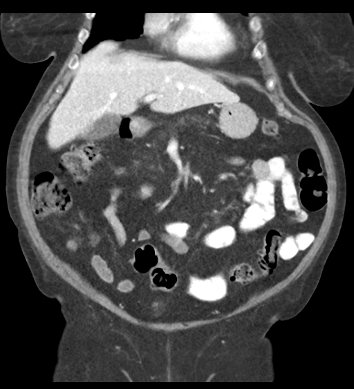 File:Cannonball metastases from endometrial cancer (Radiopaedia 42003-45031 F 26).png