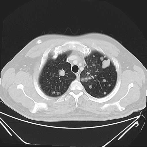 File:Cannonball pulmonary metastases (Radiopaedia 67684-77101 Axial lung window 5).jpg