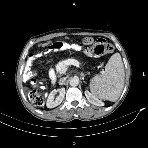 Caput medusae sign - portal hypertension (Radiopaedia 64007-72759 A 29).jpg