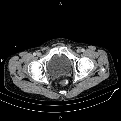 Caput medusae sign - portal hypertension (Radiopaedia 64007-72759 A 97).jpg