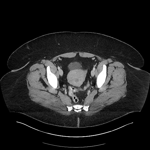 Carcinoid tumor - terminal ileum (Radiopaedia 60931-68739 A 116).jpg
