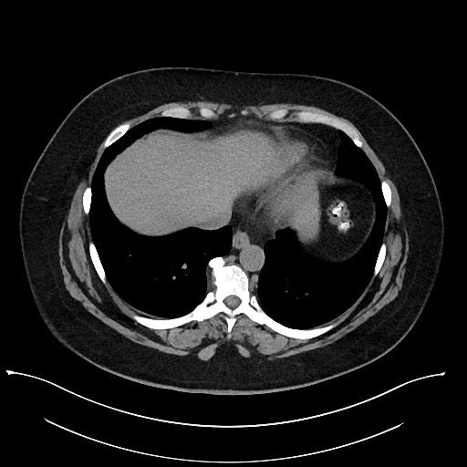 Carcinoid tumor - terminal ileum (Radiopaedia 60931-68740 Axial non-contrast 2).jpg