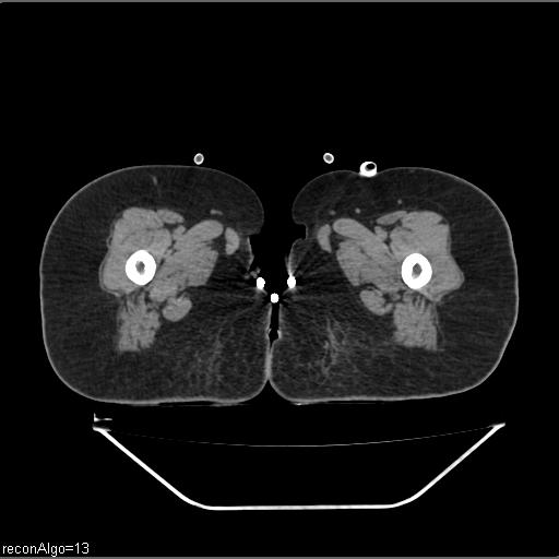 Carcinoma cervix- brachytherapy applicator (Radiopaedia 33135-34173 Axial non-contrast 66).jpg