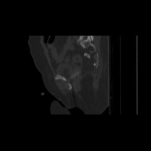 Carcinoma cervix- brachytherapy applicator (Radiopaedia 33135-34173 Sagittal bone window 117).jpg