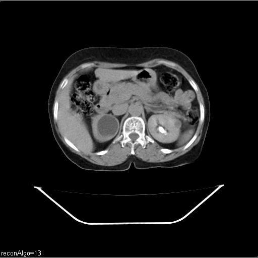 File:Carcinoma cervix- recurrence (Radiopaedia 34702-36137 Axial C+ delayed 5).jpg