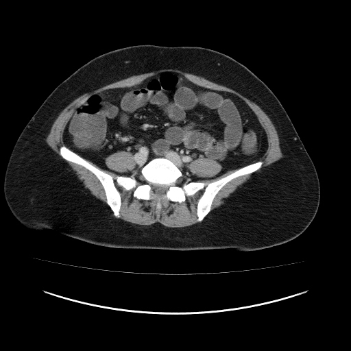 File:Carcinoma colon - hepatic flexure (Radiopaedia 19461-19493 A 87).jpg