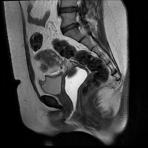 File:Carcinoma of the cervix (Radiopaedia 89018-105858 Sagittal T2 10).jpg