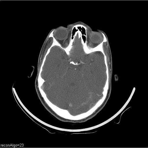 Carcinoma of the maxillary antrum (Radiopaedia 53805-59888 Axial C+ delayed 69).jpg