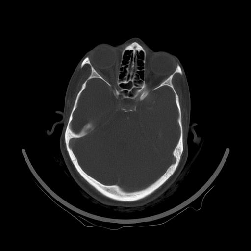Carcinoma of the maxillary antrum (Radiopaedia 53805-59888 Axial bone window 18).jpg