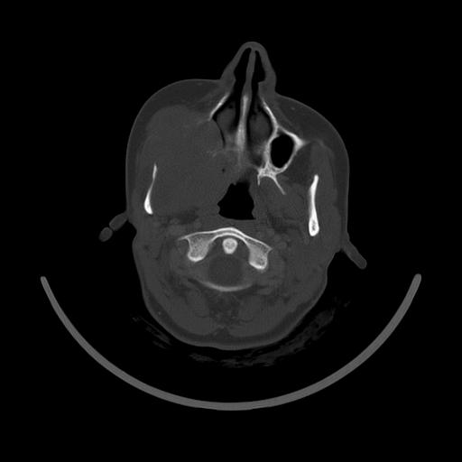 Carcinoma of the maxillary antrum (Radiopaedia 53805-59888 Axial bone window 61).jpg