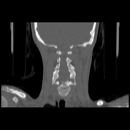 Carcinoma of the maxillary antrum (Radiopaedia 53805-59888 Coronal bone window 114).jpg