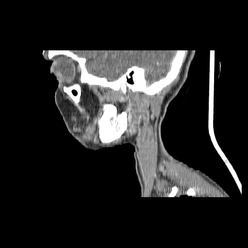 Carcinoma of the maxillary antrum (Radiopaedia 53805-59888 Sagittal C+ delayed 143).jpg
