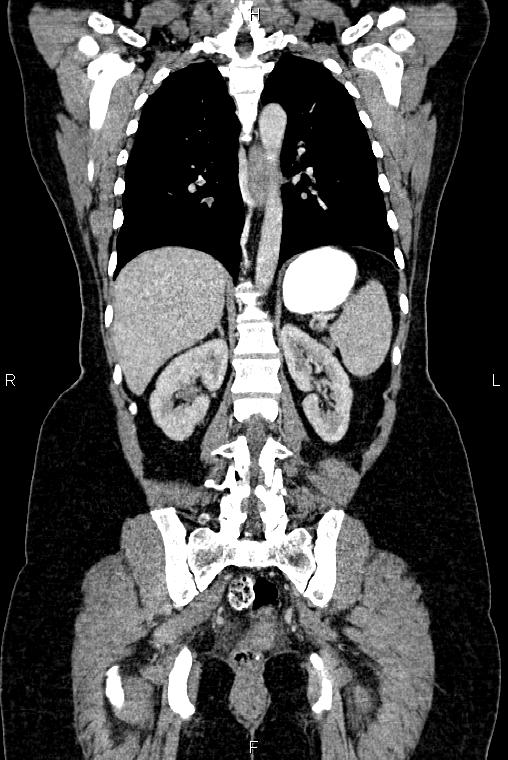 Carcinoma of uterine cervix (Radiopaedia 85861-101700 C 39).jpg