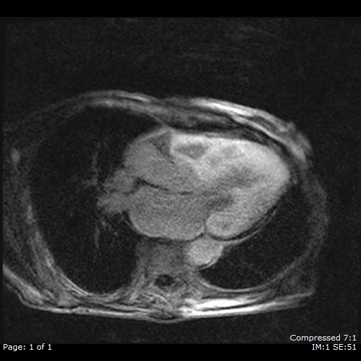 File:Cardiac amyloidosis (Radiopaedia 62017-70102 3ch LGE 1).jpg