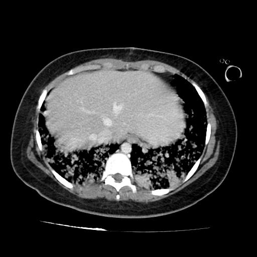 File:Cardiac angiosarcoma (Radiopaedia 66010-75181 B 68).jpg