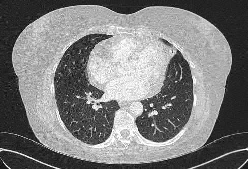 Cardiac sarcoidosis (Radiopaedia 74548-85534 Axial lung window 54).jpg