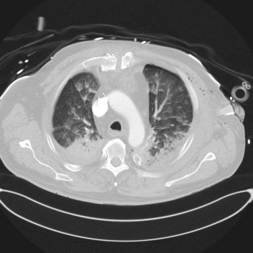 Cardiac trauma (Radiopaedia 32874-33858 Axial lung window 17).jpg