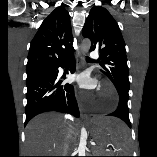 Cardiac tumor - undifferentiated pleomorphic sarcoma (Radiopaedia 45844-50134 Coronal non-contrast 40).png