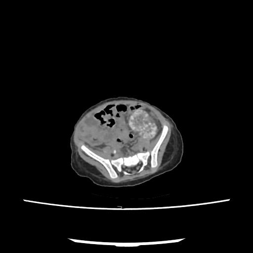 File:Caroli disease with autosomal recessive polycystic kidney disease (ARPKD) (Radiopaedia 89651-106703 E 185).jpg