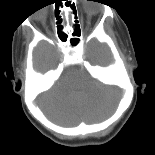 File:Carotid body tumor (paraganglioma) (Radiopaedia 38586-40729 A 2).jpg