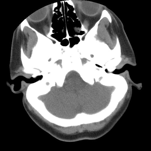 Carotid body tumor (paraganglioma) (Radiopaedia 38586-40729 A 40).jpg