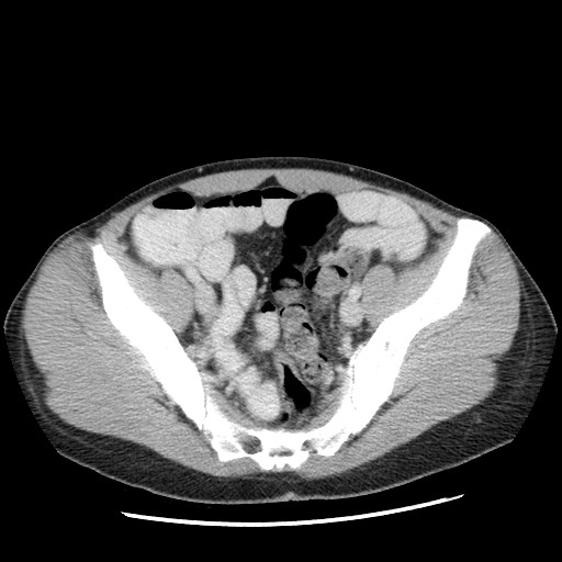 File:Castleman disease with fibrous pseudotumor in the abdomen (Radiopaedia 77296-89373 A 101).jpg
