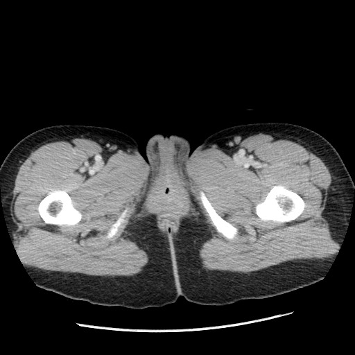 File:Castleman disease with fibrous pseudotumor in the abdomen (Radiopaedia 77296-89373 Axial 140).jpg